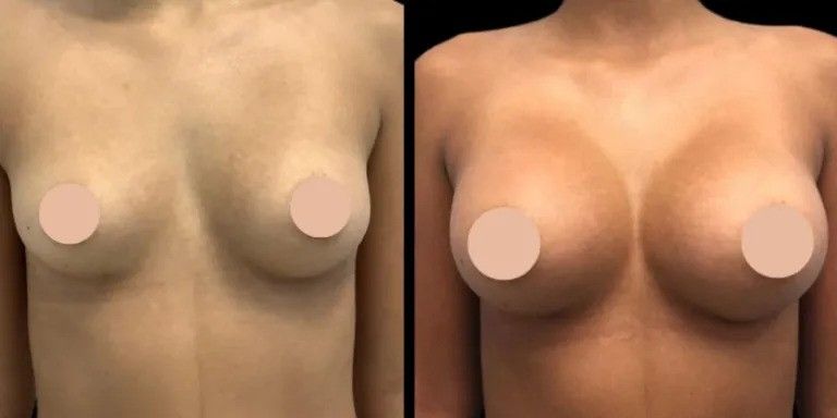 Best Breast Augmentation Surgeon in Dubai Reveals Common Myths About Surgery